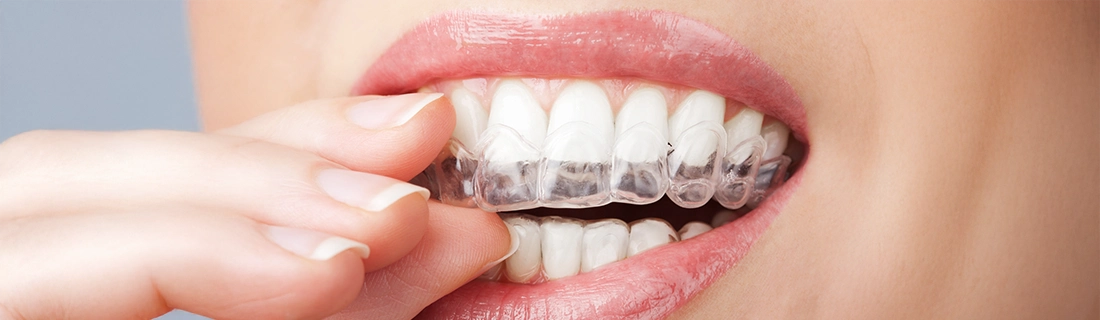Invisalign® vs. Braces In Raleigh NC: Transform Your Smile with the Best Choice!
