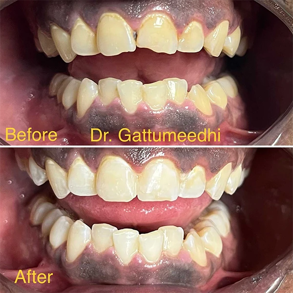 Dentist Raleigh NC Smile Gallery Before & After Dentist Raleigh NC Smile Gallery Before & After