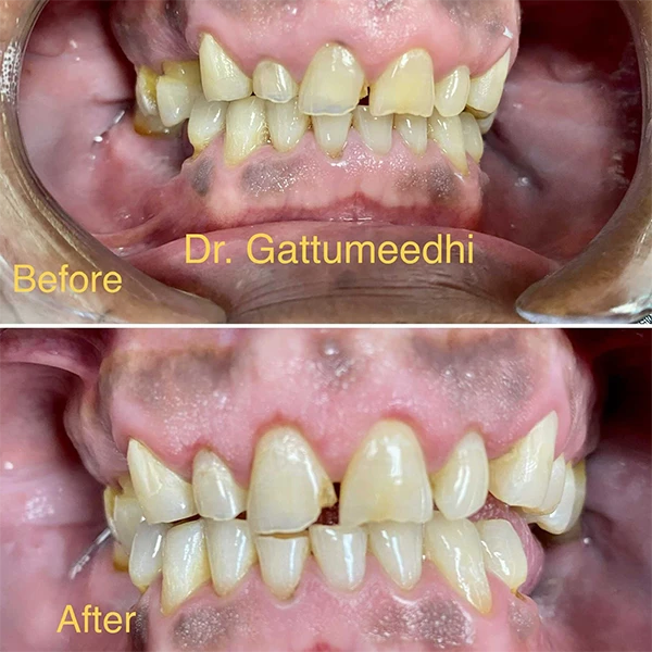 Dentist Raleigh NC Smile Gallery Before & After Dentist Raleigh NC Smile Gallery Before & After