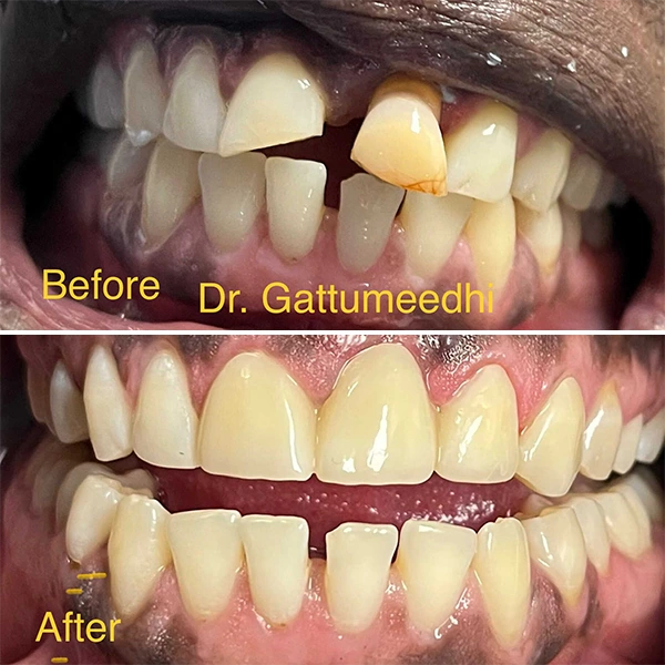 Dentist Raleigh NC Smile Gallery Before & After Dentist Raleigh NC Smile Gallery Before & After