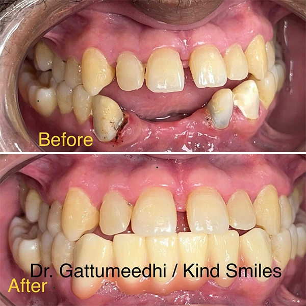 Dentist Raleigh NC Smile Gallery Before & After Dentist Raleigh NC Smile Gallery Before & After