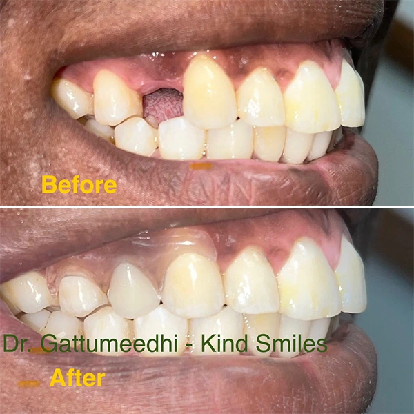 Dentist Raleigh NC Smile Gallery Before & After Dentist Raleigh NC Smile Gallery Before & After